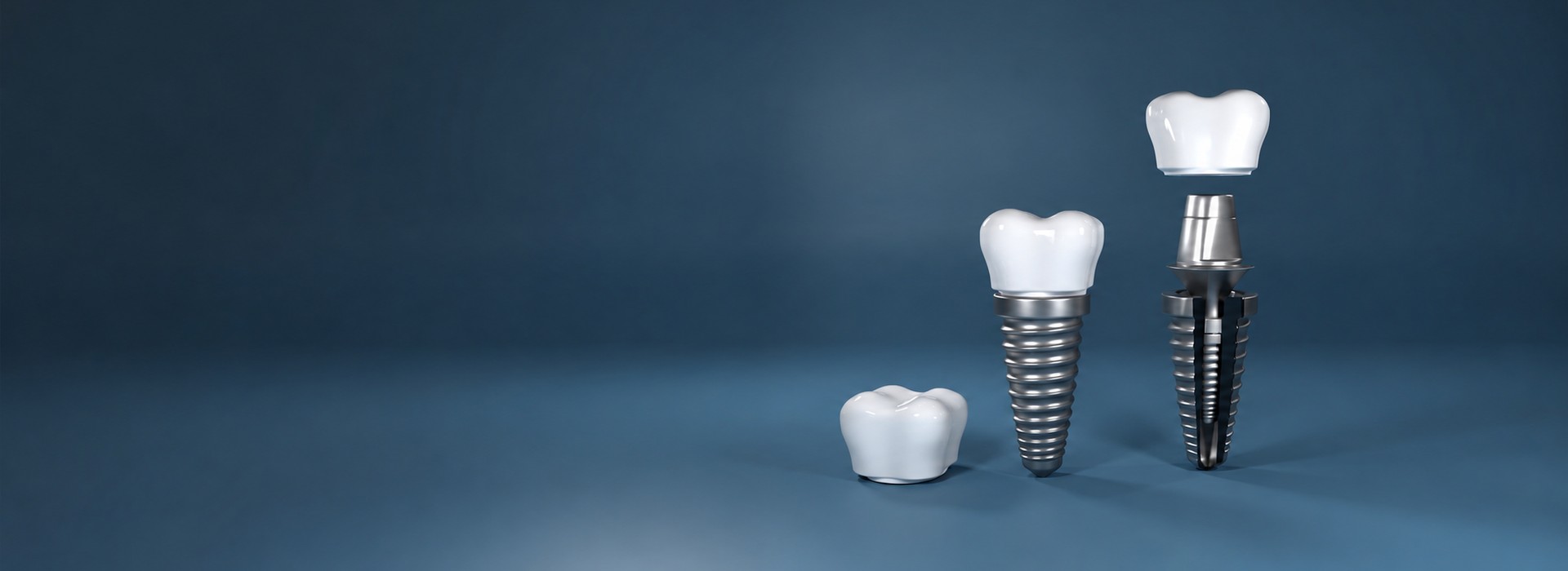 Implantes Dentales en Valencia